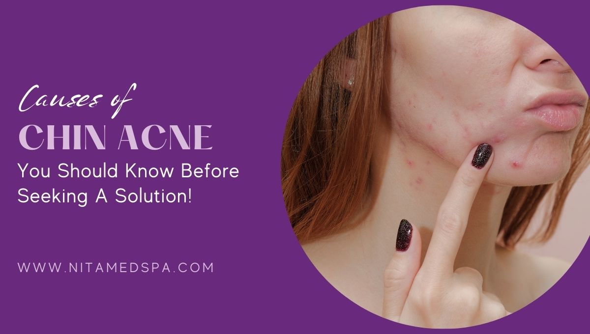 chin acne causes