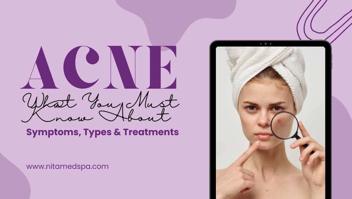 acne symptoms and treatment